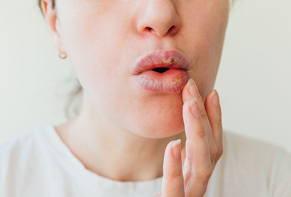 Bibir Bengkak